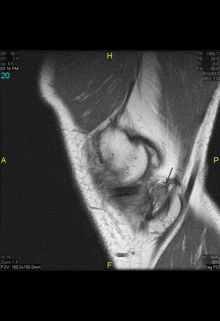 Figure 7 for case gout arthritis ( RID3567 )
